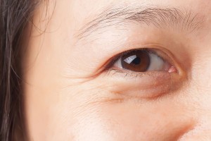 causes-bags-under-eyes