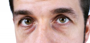 causes-dark-circles-eyes