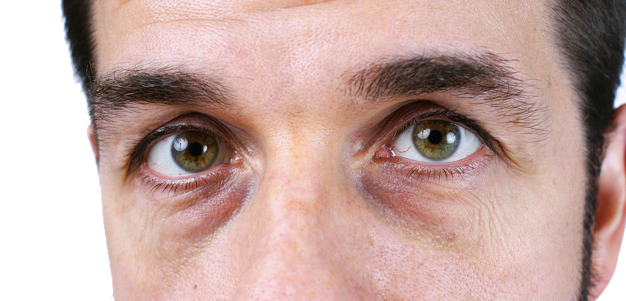 What Causes Dark Circles Under Your Eyes? - Real Simple